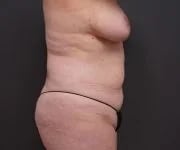 before tummy tuck right side view of female patient 2280