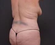 before tummy tuck rear right angle view of female patient 2280