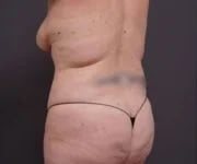 before tummy tuck left angle view of female patient 2280