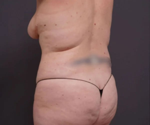before tummy tuck left angle view of female patient 2280