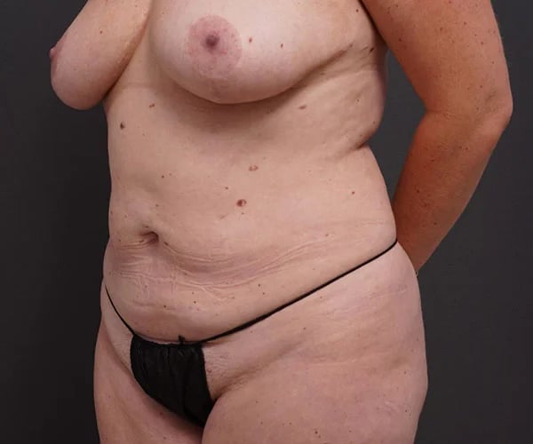 before tummy tuck left angle view of female patient 2280