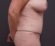 after tummy tuck right side view of female patient 2280