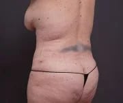 after tummy tuck left angle rear view of female patient 2280