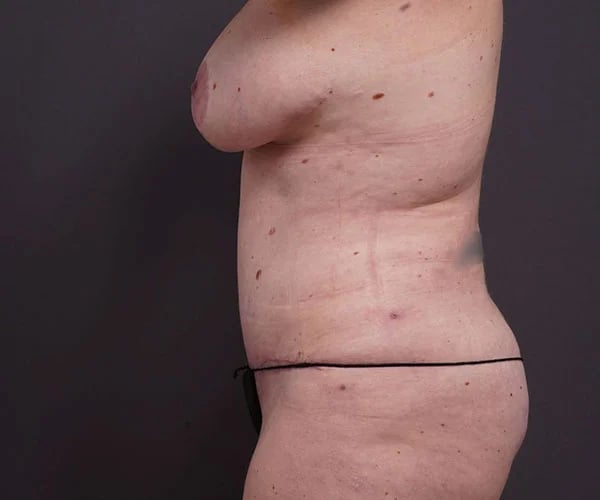 after tummy tuck left side view of female patient 2280