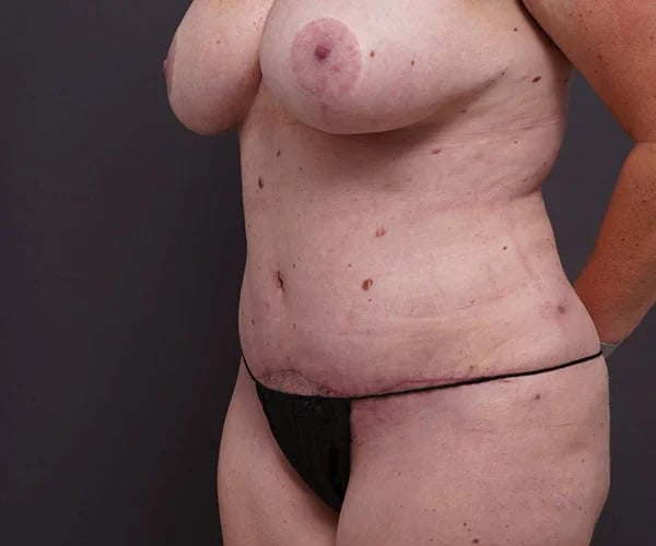 after tummy tuck left angle view of female patient 2280