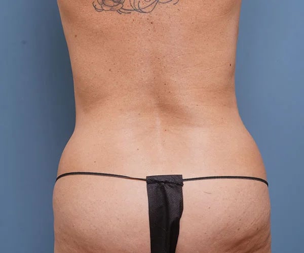 before tummy tuck rear view of female patient 2302