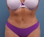 after tummy tuck front view of female patient 2302