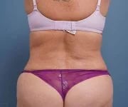 after tummy tuck rear view of female patient 2302