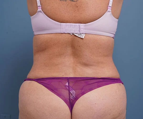 after tummy tuck rear view of female patient 2302