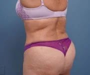 after tummy tuck left rear angle view of female patient 2302