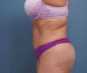after tummy tuck left side view of female patient 2302