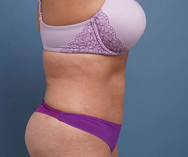 after tummy tuck right side view of female patient 2302