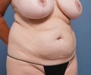 before tummy tuck right angle view female patient case 2351