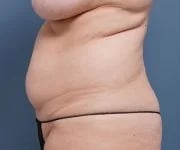 before tummy tuck left side view female patient case 2351