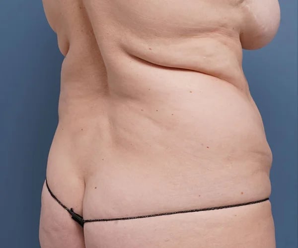 before tummy tuck right angle view female patient case 2351