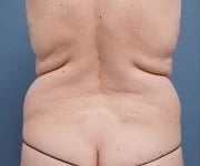 before tummy tuck back view female patient case 2351