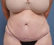 after tummy tuck front view female patient case 2351