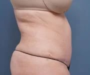 after tummy tuck right side arms up view female patient case 2351