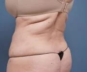 after tummy tuck left angle view female patient case 2351