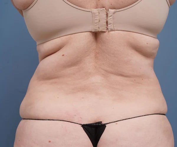 after tummy tuck back view female patient case 2351