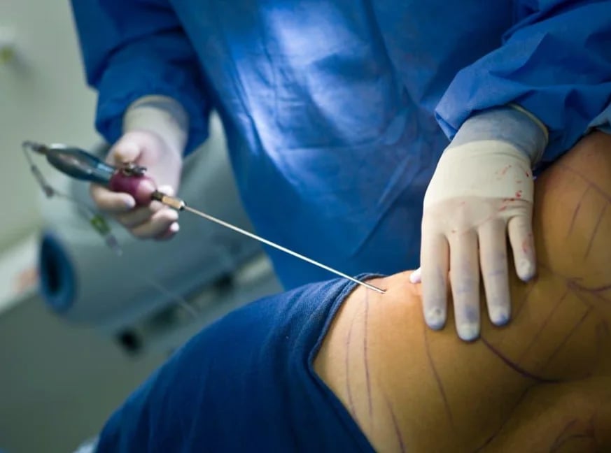 Liposuction cannula harvesting fat for transfer during a Lipo 360 procedure
