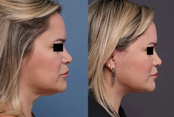 Neck Lift in Palm Beach: Everything You Need to Know