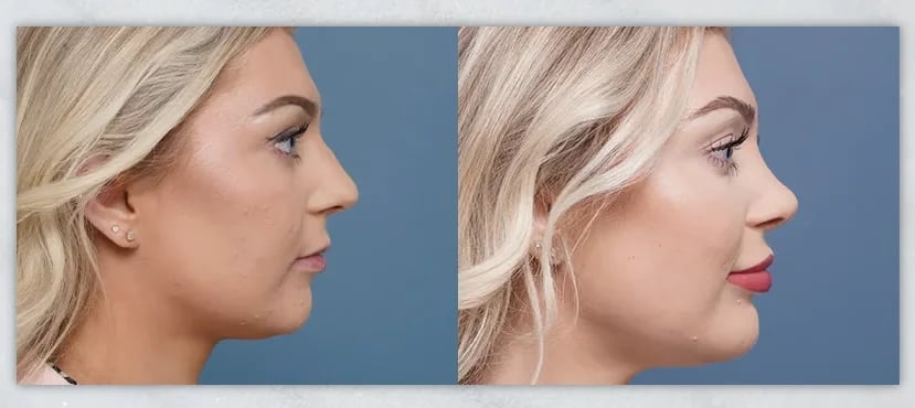 Teenage Rhinoplasty in Palm Beach: When Is a Teen Ready for Nose Surgery