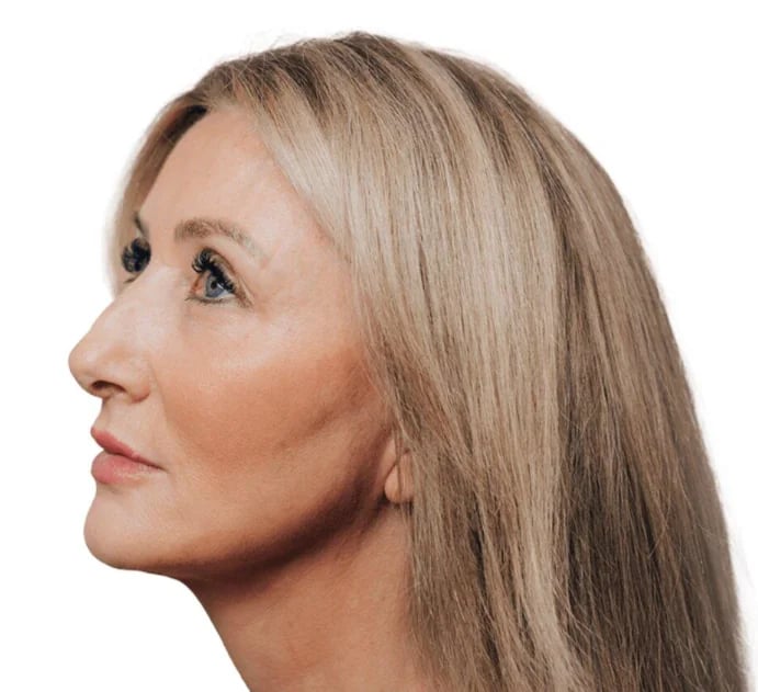 Profile view of a mature patient considering facial surgery