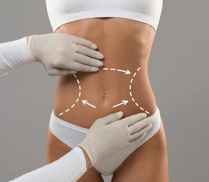 The circumferential treatment areas Lipo 360 addresses around the midsection