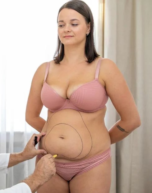 Surgeon marking a patient's abdomen during Lipo 360 pre-operative planning