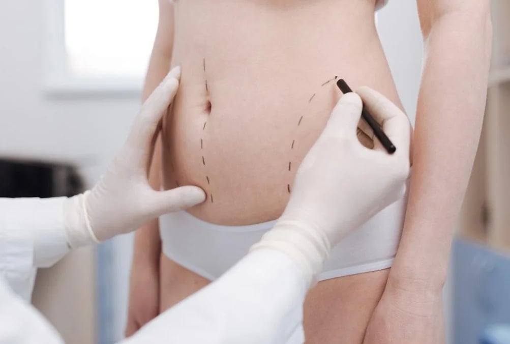 Surgeon marking treatment areas on a patient's abdomen before Lipo 360
