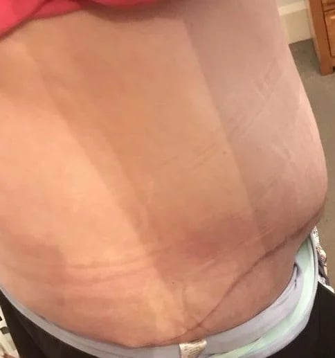 Fluid collection visible in the abdomen after body contouring surgery